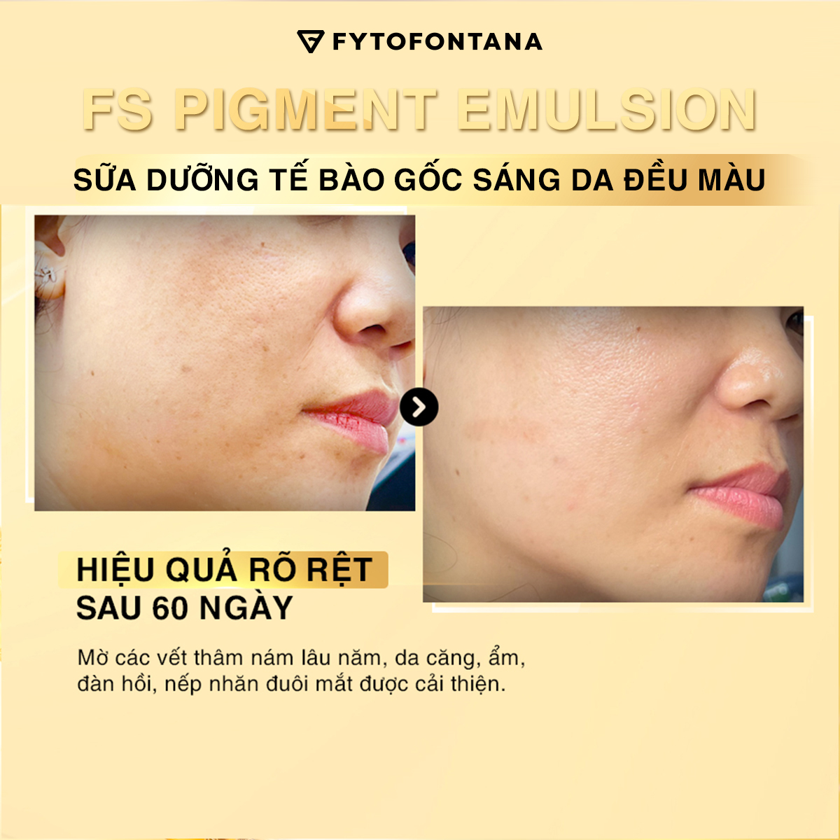 Hiệu quả sau 60 ngày từ mỹ phẩm tế bào gốc cao cấp Fytofontana