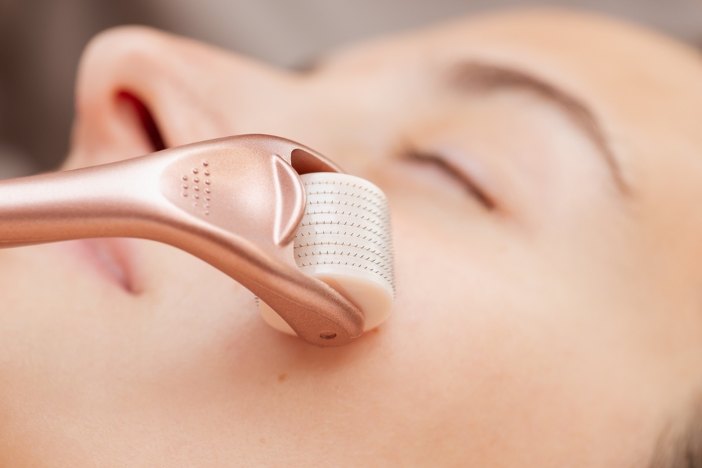 Lăn kim tế bào gốc để điều trị nám