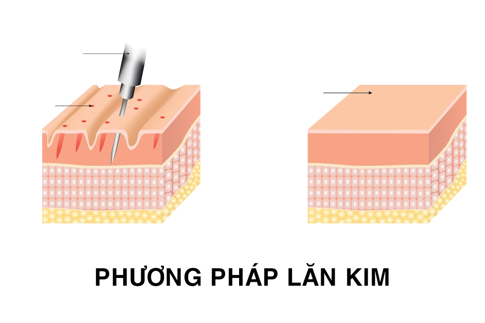 Cơ chế sau lăn kim sử dụng tế bào gốc