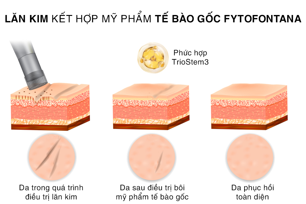 hiệu quả phi kim kết hợp mỹ phẩm tế bào gốc