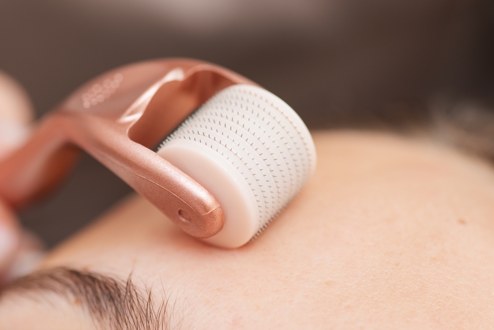 Mỹ phẩm tế bào gốc kết hợp với lăn kim để điều trị sẹo rỗ