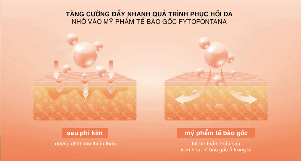quá trình phục hồi da sau lăn kim nhờ vào mỹ phẩm tế bào gốc