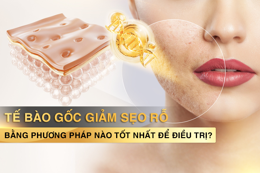 tế bào gốc giảm sẹo rỗ