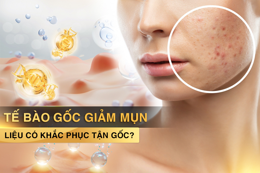 tế bào gốc trị mụn