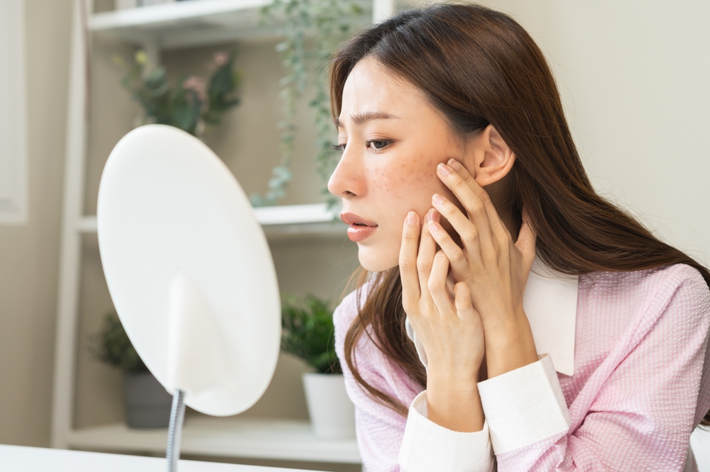 Tế bào gốc trị nám là gì?