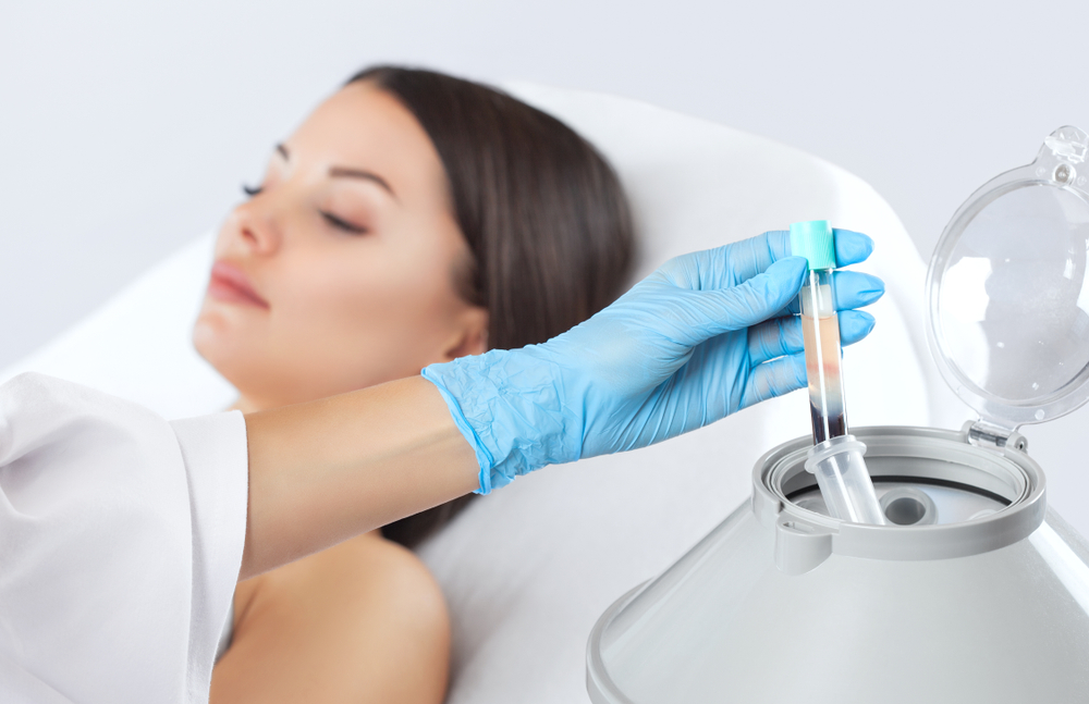 Tế bào gốc trị sẹo rỗ bằng PRP