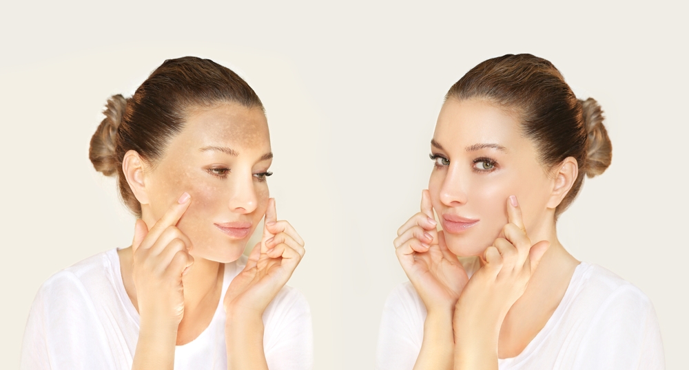 trước và sau tế bào gốc trị nám