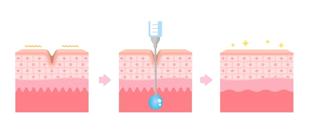 độ hiệu quả của botox 100 đối với làn da