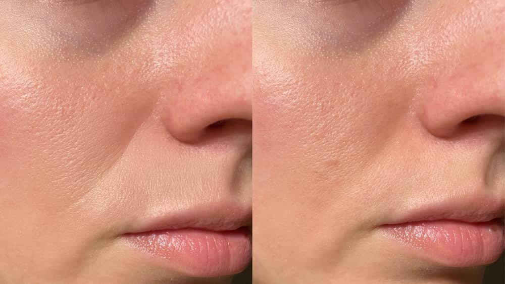 trước và sau sử dụng botox serum