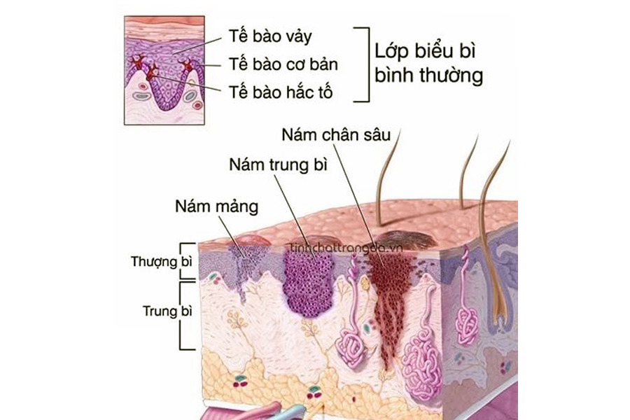 3 loại nám da thường gặp