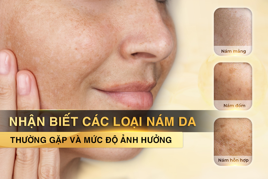 các loại nám da