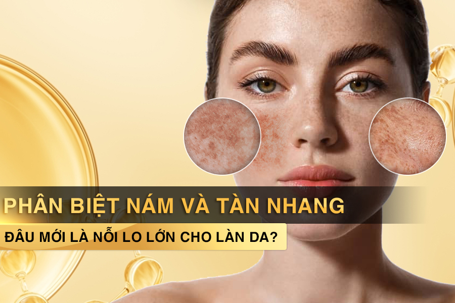 phân biệt nám và tàn nhang