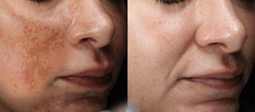 before after giảm nám da vùng mặt bằng mỹ phẩm tế bào gốc