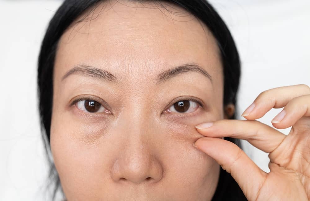 các loại nếp nhăn dưới mắt