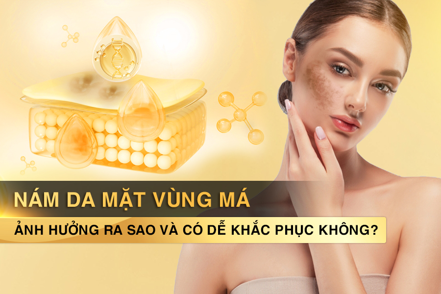 nám da mặt vùng má