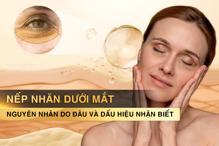 nếp nhăn dưới mắt