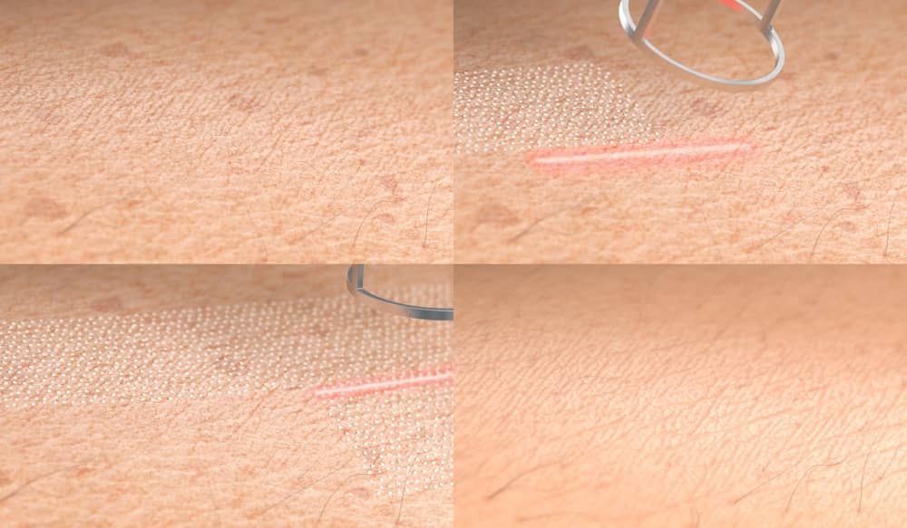 tình trạng da sau khi thực hiện laser co2