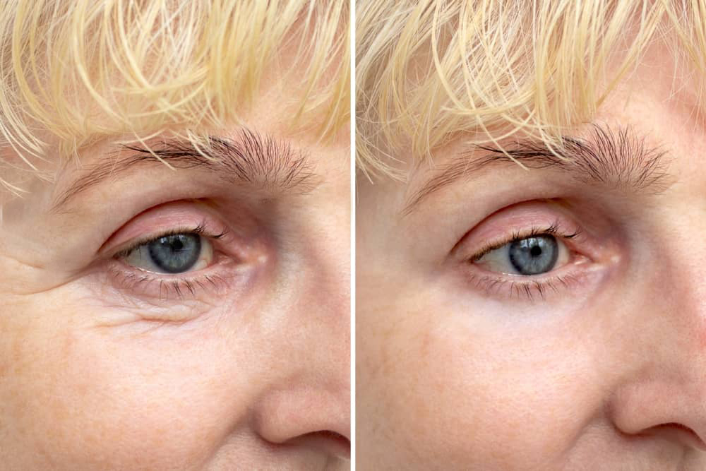 trước sau sử dụng fs eyecontour