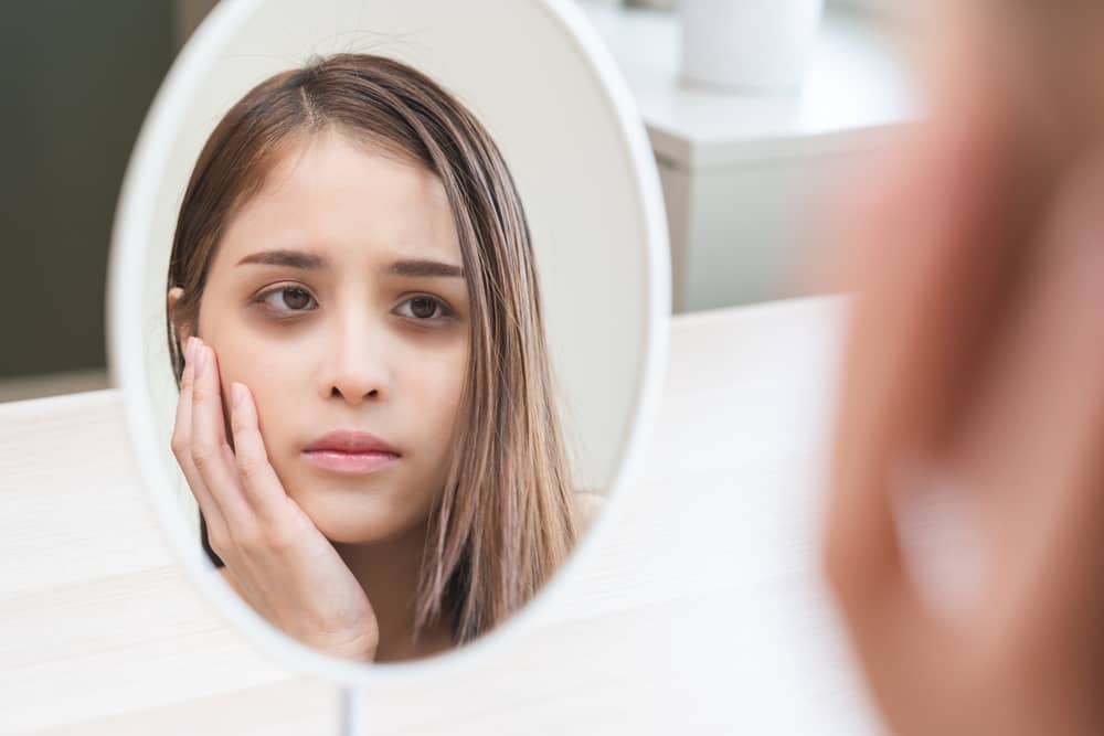 thâm quầng mắt do cấu trúc