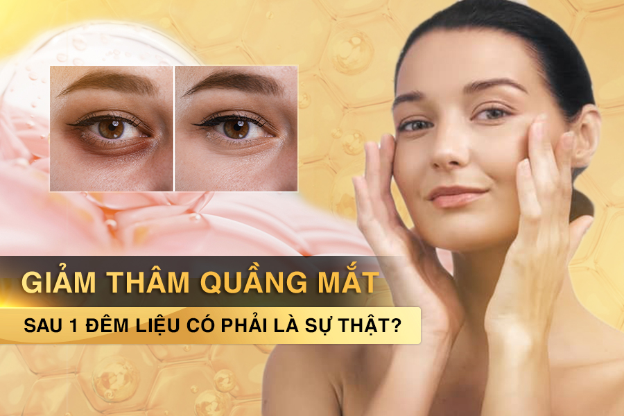 trị thâm quầng mắt sau 1 đêm